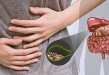 Waspadai Makanan Penyebab Batu Empedu yang Sering Dikonsumsi Sehari-hari