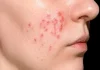 Berapa Lama Jerawat Hormonal Bisa Hilang? Ini Jawaban Dokter Kulit