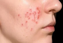 Berapa Lama Jerawat Hormonal Bisa Hilang? Ini Jawaban Dokter Kulit