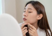 Jerawat di Dagu Membandel? Rahasia Penyebab dan Solusi Ampuh yang Wajib Dicoba