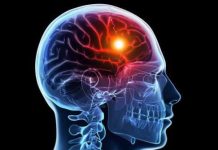 Waspada! Ini Tanda Stroke Tersembunyi yang Sering Terjadi di Usia Muda
